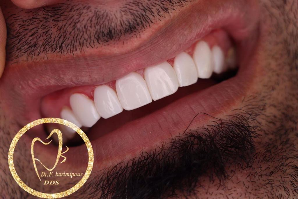 ایمپلنت دندان برای جایگزینی دندان‌های از دست رفته